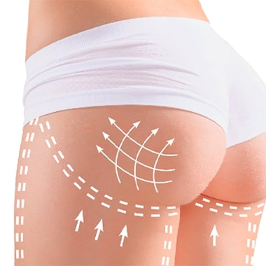 Cirugia de Gluteoplastia